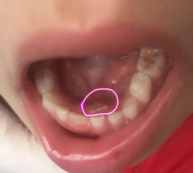 健康园地 > 正文 2,如果咬出来的苹果是这样的(见下图),那么,双排牙齿